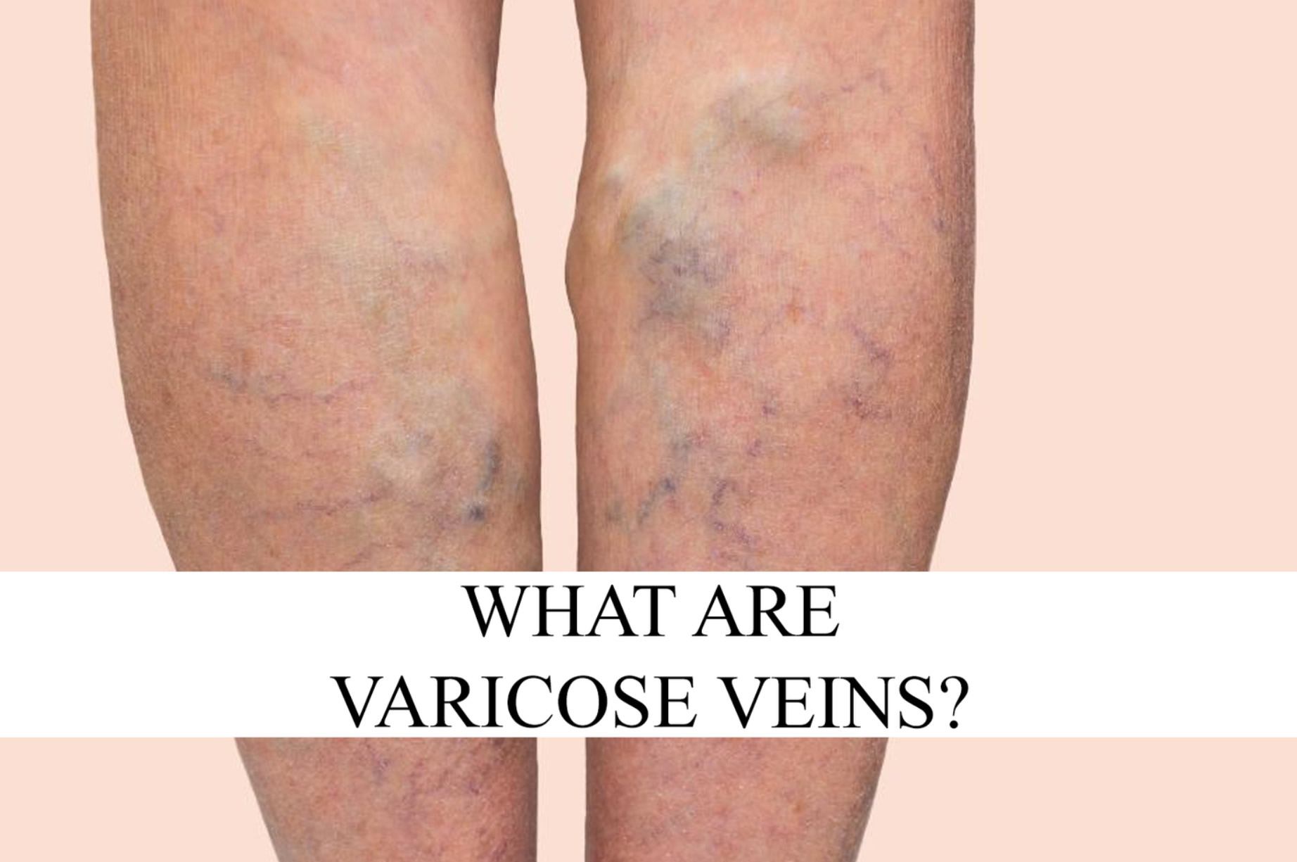 Tratamentul metodei varicose varicose chichagov - Mesoterapia corporală și varicoză